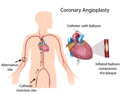 Angioplasty