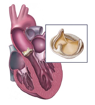 Heart valve replacement surgery