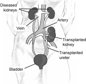 Kidney transplant