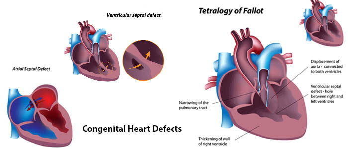 Paediatric heart surgery