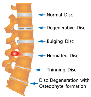 Lumbar spine surgery