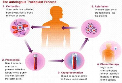 Bone marrow transplant