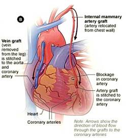 Heart bypass surgery