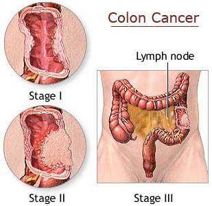 Colon cancer treatment