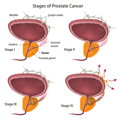 Prostate cancer treatment