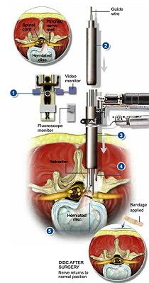 Slip disc treatment in India