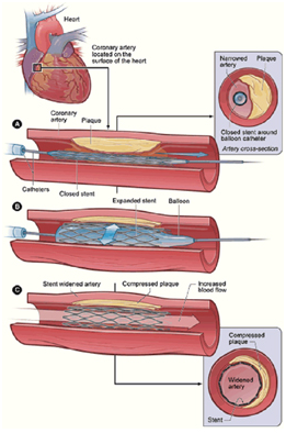 Angioplasty