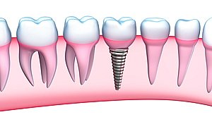 Dental Implants