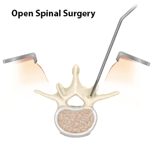 Minimally Invasive Spine Surgery