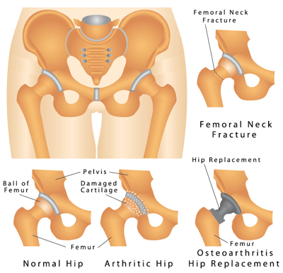Hip Replacement