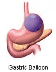 Gastric Balloon