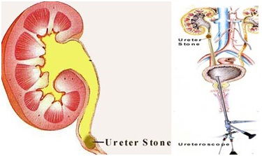 Best Varicocele Treatment