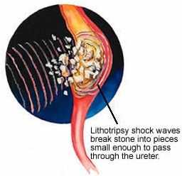 Best Varicocele Treatment
