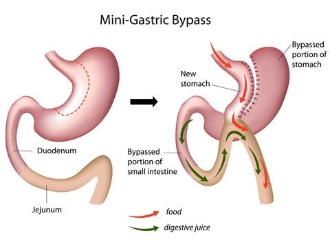 Mini Gastric Bypass Surgery