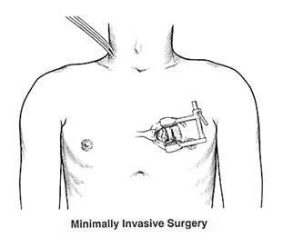 Minimally invasive heart surgery