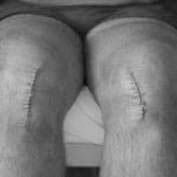 Minimally Invasive Knee Replacement