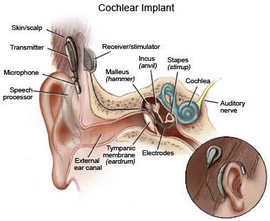 Cochlear implant surgery