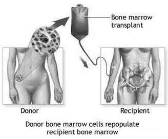 Bone marrow transplant
