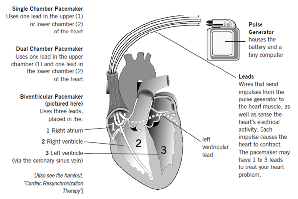 Pacemaker Implantation