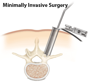 Minimally Invasive Spine Surgery