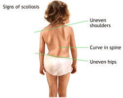 Scoliosis surgery