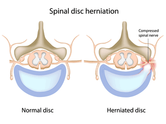 Slip disc treatment in India