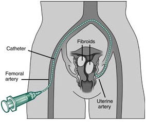 Fibroids Treatment